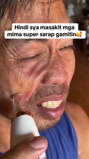 Super effective blackhead & whitehead vacuum | gentle, painless removal