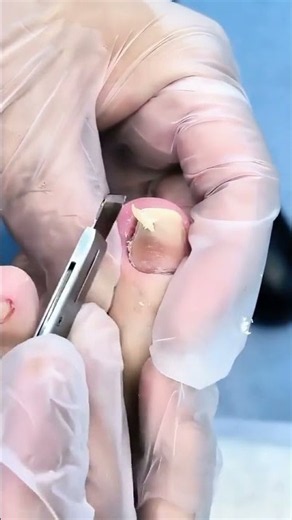ingrown toenail removal. #footcare #satisfying #simplenails #asmrpedicure #ingrowntoenail #pedicure
