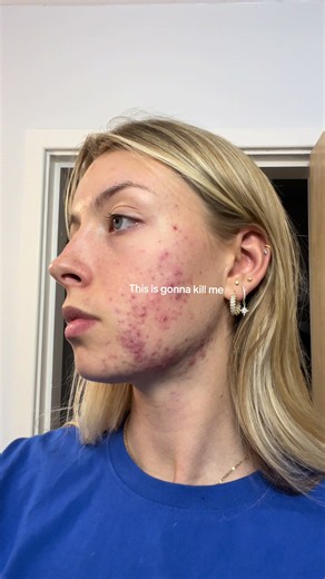 My Accutane Journey: 4 Years of Acne & My Final Solution