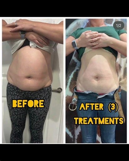 Cryolipolysis before and after results