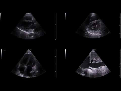The Hypotensive Patient: A Systematic Approach with POCUS