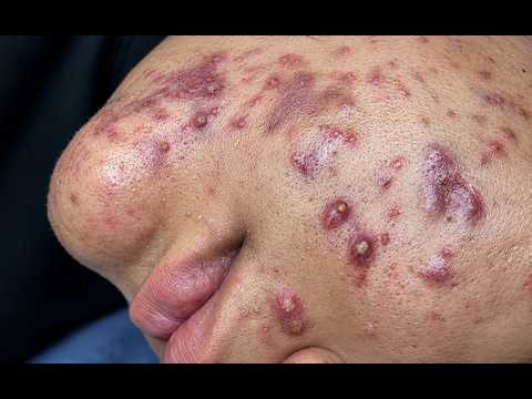 NEW 2026 🔥 Satisfying Acne Extraction | Deep Pimple Cleaning#10358