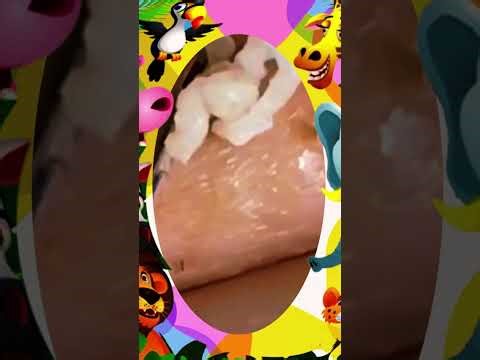 Blackheads Removal #385 | Acne Treatment and Very Satisfying Satisfying Pimple pop #blackheads