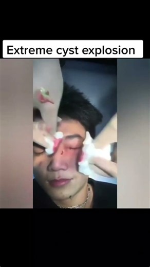 Extreme cyst exploded