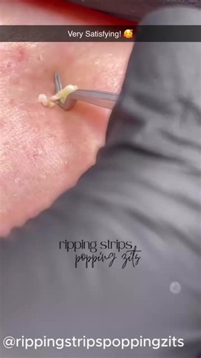 1 likes | Mr. Pimple Popper's Most Satisfying Extraction: Watch This Juicy Blackhead Get Removed | Mr Pimple Popper (@sospecialshow) | Posted Oct 27, 2026 | Spotlight