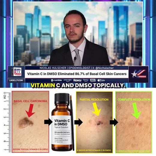 STUDY: Topical Vitamin C in DMSO ELIMINATED 86.7% of the World’s Most Common Skin Cancer Within 8 Weeks A randomized trial reported COMPLETE RESOLUTION of nearly ALL basal cell carcinoma lesions… | Nicolas Hulscher, MPH