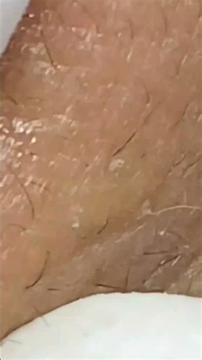 Big Cystic Acne Blackheads Extraction Blackheads & Milia, Whiteheads Removal Pimple Popping