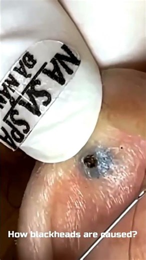 These ear blackheads are the best ones