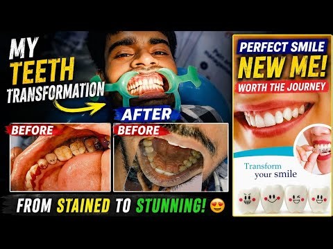 For temporary teeth for implants !Transform your smile ! #video #Teeth clinic👍🏻