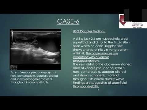 Sirisha Prabhakar : From Flow to Failure- A review of Complications of AV fistulae #sonobuzz