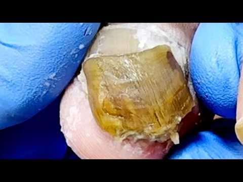 Toenails Rise Tall Buildings! Disassembly Layer By Layer【Xue Yidao】