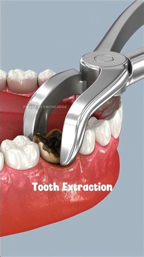The Exact Tooth Extraction Technique #healthcare #3danimation