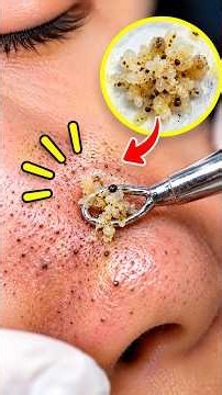 Satisfying blackhead removal videos