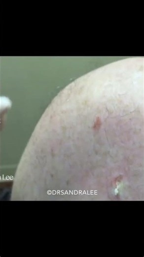 You Won't Believe What Came Out of This Pore