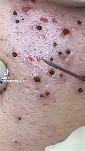 This is one of the most satisfying blackhead removal video I have ever come across https://t.co/6l5huzqwTF