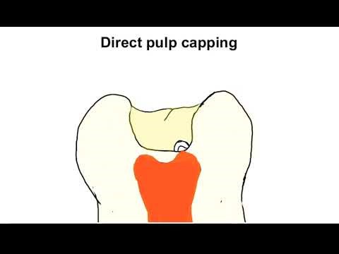 Direct pulp Capping/الخطأ الذي يضيع السن
