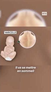 Zona : quand le virus de la varicelle se réveille | RTS