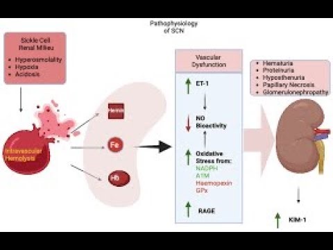 Sickle cell Anemia complications On the Urinary System Kidneys