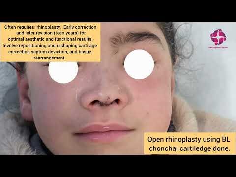 Rhinoplasty for Bifid Nose