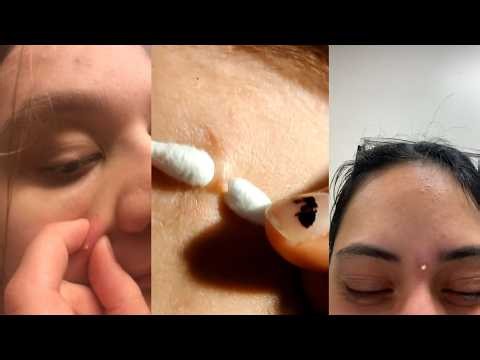 Pimple Popping - Blackheads and whiteheads removal #4