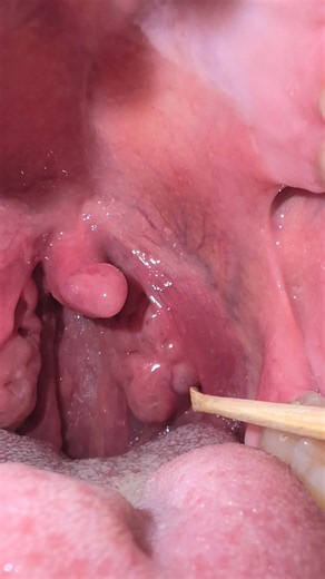 Hi there 👋 struggle with oral hygiene complications? Try the first comment or dm me with any questions! #tonsilstones #tonsiliths #mouth #asmr