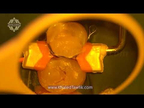 Microscopic Direct Pulp Capping of Vital Teeth Using Diode Laser and MTA