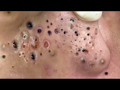 Satisfying Blackhead Removal – Deep Acne Cleaning for Ultimate Relaxation - 293433