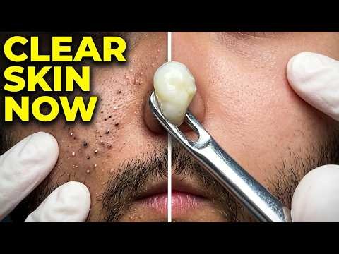 PIMPLE POPPING – Giant Cyst Explosion with Dr. Style Extraction | Pimple Doma