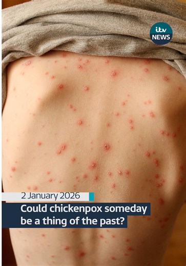 Introducing Chickenpox Vaccine through NHS MMR Jab