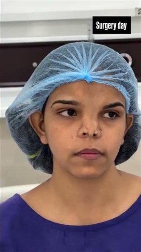 Tessier 14 Craniofacial Cleft | Reconstructive Rhinoplasty surgery in progress .