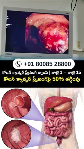 Colon Cancer Screening Camp | July 1 – July 15 | 50% Off Colon Cancer Screening