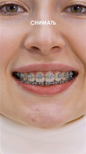 Braces with installation and system for 21,990, Aligners for 149,990. More info on Telegram: 8969...