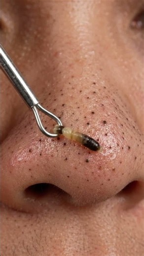 Satisfying blackhead removal in extreme close-up