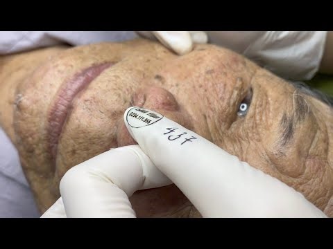 Deep Acne Extraction for Elderly Gentleman | Spa Linh Mun Pimple Popping Compilation