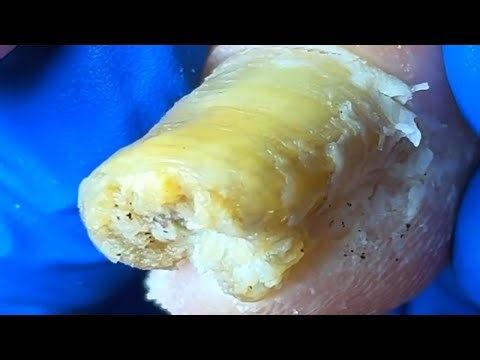 Extremely Long And Curly Onychomycosis! Professional Pedicure Procedure【Xue Yidao】