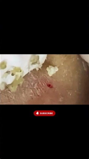 4K Ultra Close-Up Blackhead Removal 😱 #shorts