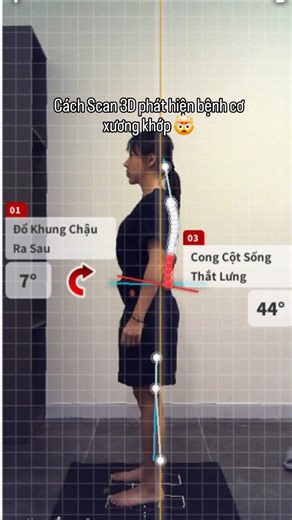 Reborn.physicaltherapy on Instagram: "🔥 ĐỘC QUYỀN CÔNG NGHỆ SCAN 3D AI TẠI TP. HCM Scan 3D AI là công nghệ quét hình thể bên ngoài cơ thể bằng ánh sáng laser và ánh sáng cấu trúc, kết hợp trí tuệ nhân tạo (AI) để dựng lại mô hình 3D tư thế cơ thể. Công nghệ này không dùng tia X, không xâm lấn, không gây đau, và an toàn khi cần kiểm tra nhiều lần. Điểm quan trọng nhất: 👉 Scan 3D AI tại Reborn KHÔNG sử dụng tia X như CT hay X-quang. Thay vào đó, hệ thống sử dụng ánh sáng laser và ánh sáng cấu tr