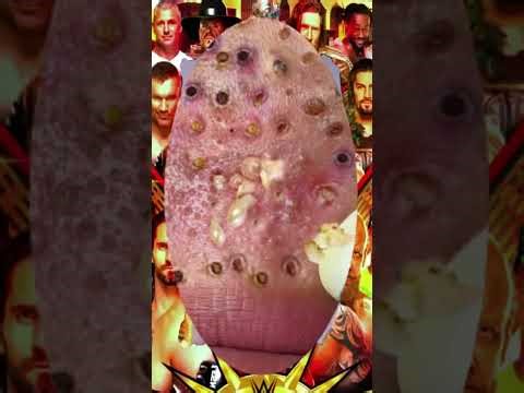 Blackheads Removal #259 | Acne Treatment and Very Satisfying Satisfying Pimple pop #blackheads