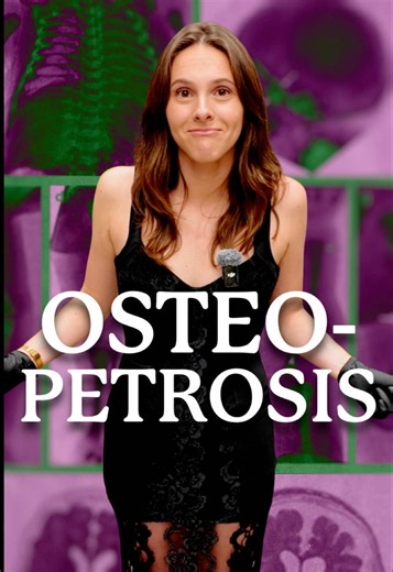 What happens when bones become too dense to break down properly? In this video, we explore osteopetrosis, a rare genetic condition that causes bones to become unusually dense. But greater density doesn’t mean greater strength. Affected bones can actually be more brittle and prone to fractures. A fascinating reminder that the strength of our skeleton depends on more than just how much bone we have. #bonetok #learnontiktok #edutok #learnontiktokcontest