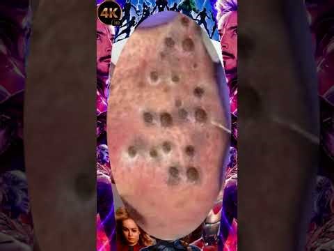 Blackheads Removal #137 | Acne Treatment and Very Satisfying Satisfying Pimple pop #blackheads