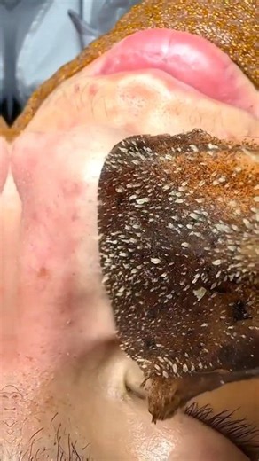 Remove Blackheads & Whiteheads Naturally At Home . . . #blackheads #whiteheads #blackheadsremoval #whiteheadsremoval #skincare #reelsvideoシ #reelsviralシ #fbreelsfypシ゚ #fbreelsvideo #fblifestyle #reelschallenge | Natural Beauty Remedy
