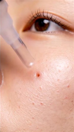 UNDER-EYE & CHEEK BLACKHEAD VACUUM EXTRACTION