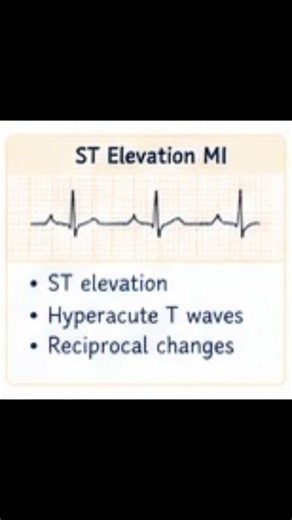 ECG Interpretation Made Easy! 📈#ECG #Medicine #Shorts
