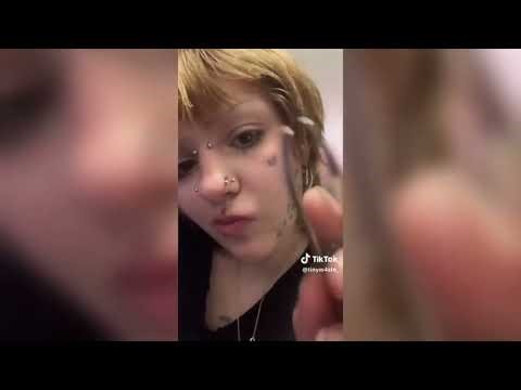 Pimple Popping - Ultimate Pimple Popping Compilation#88