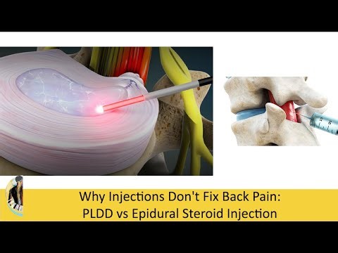 Why Injections Don't Fix Back Pain: PLDD vs Epidural Steroid Injection