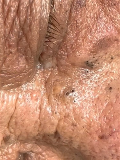 OMG 😱 Huge blackheads removal! #blackheadsremove #foryou #treandingvideo #viralvideo