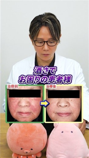 Rosacea Treatment Case Study at the Niiza Clinic✨