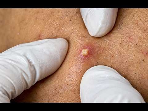 NEW 2026 🤯 Incredible Pimple Popping & Blackhead Removal#10361