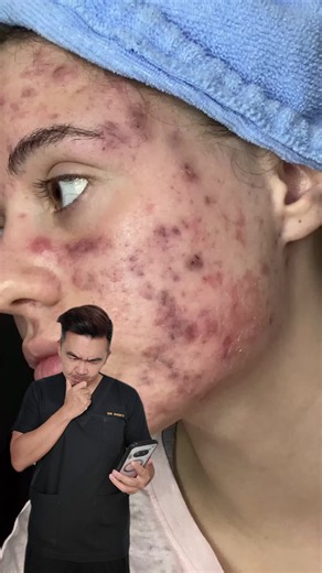 Severe Acne & Red Marks: Causes, Treatments, and When to See a Dermatologist