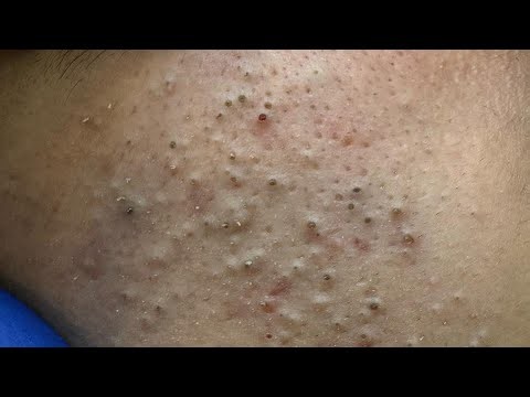 Deep Pore Cleansing | Acne Treatment, Blackheads Removal & Facial Care
